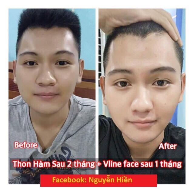 Tinh chất thon hàm má, thu xương quai hàm, hạ gò má cao | BigBuy360 - bigbuy360.vn