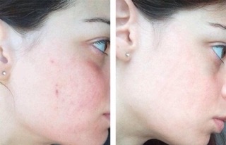 SERUM The Odinary 30ml và 60ml
