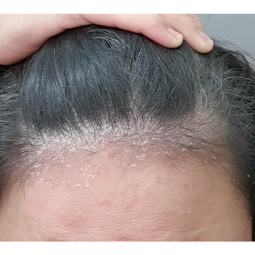 Dầu Gội Sạch Gàu Chiết Xuất Dược Liệu Antisol - Hiệu Quả Nhanh, An Toàn Tuyệt Đối SACUCO