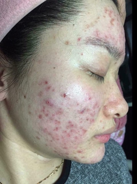 Tone trị mụn của Nhật | BigBuy360 - bigbuy360.vn