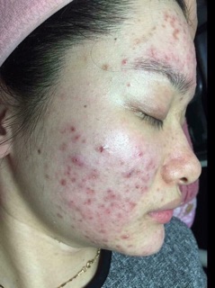 Tone trị mụn của Nhật - hip1994@