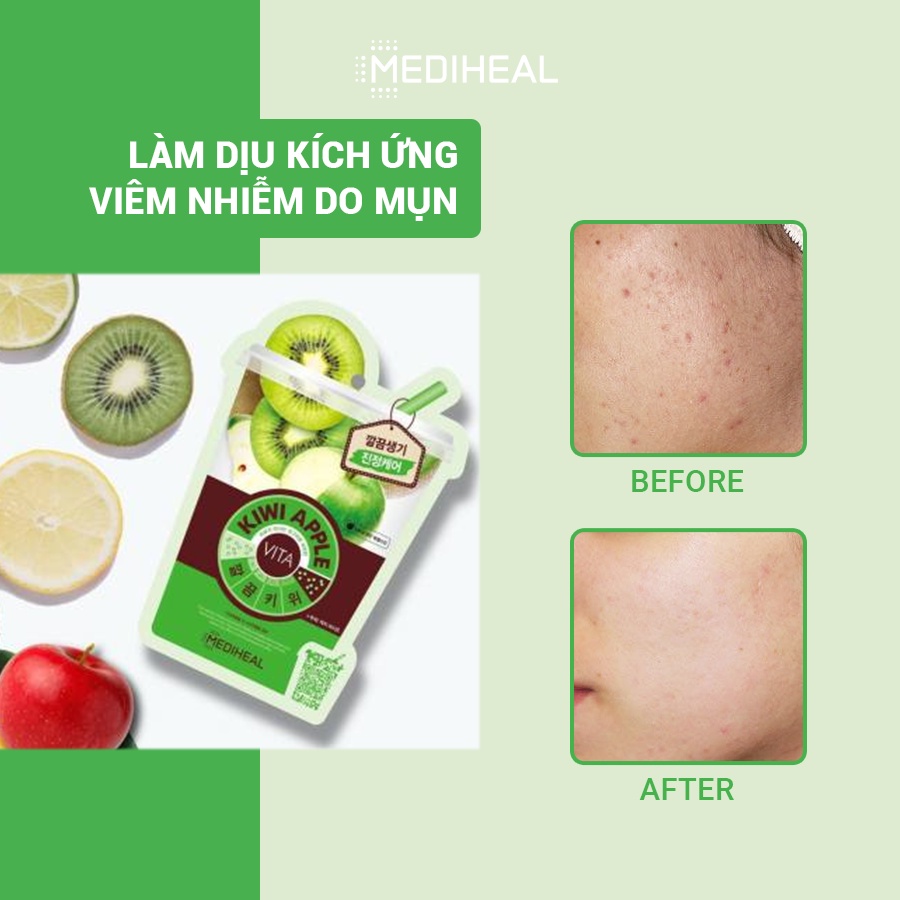 Mặt Nạ Tinh Chất Kiwi Táo Giúp Da Mềm Mịn Và Khỏe Mạnh Mediheal Kiwi Apple Vita Mask 20ml [K15]