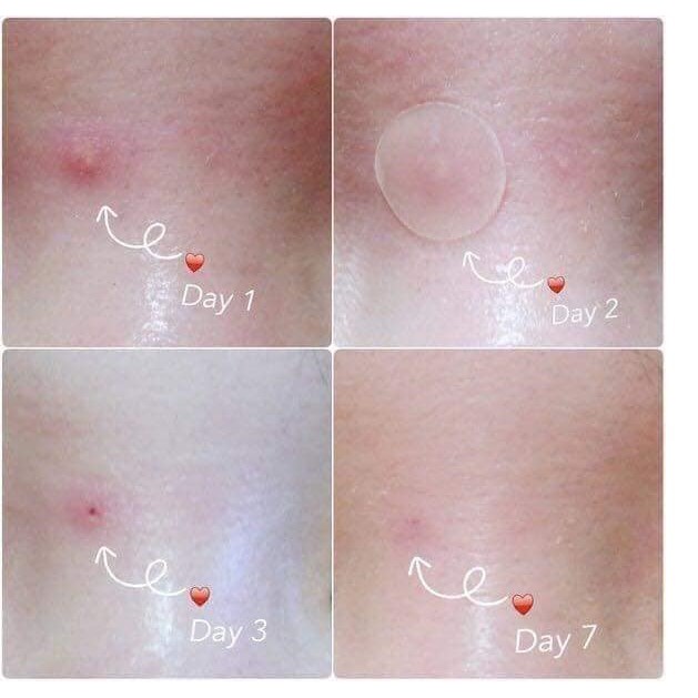 Miếng dán Mụn Ciracle Red Spot Acne Pimple Path 24 Miếng