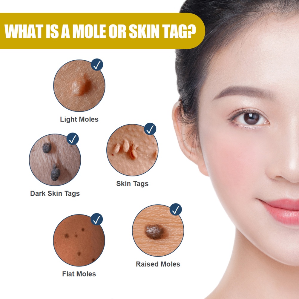 Tinh chất tẩy khuyết điểm trên EELHOE không đau làm sạch nốt ruồi/ vết thâm mụn cóc tàn nhang