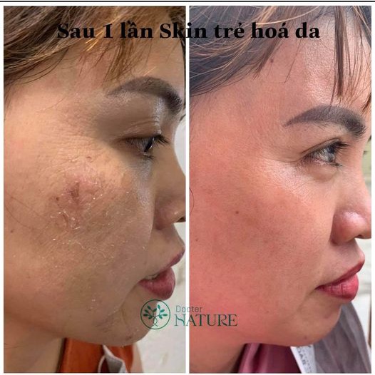 PEEL SKIN DOCTOR NATURE
