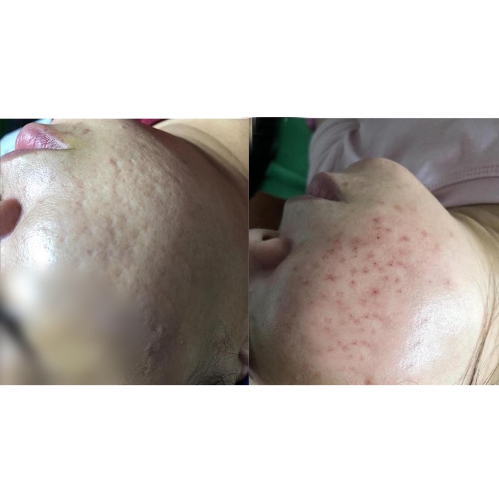 Cứu Tinh Face 5ml cấp nước & phục hồi da Mh Beauty Spa