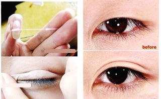 Chỉ kích mí Hàn Quốc