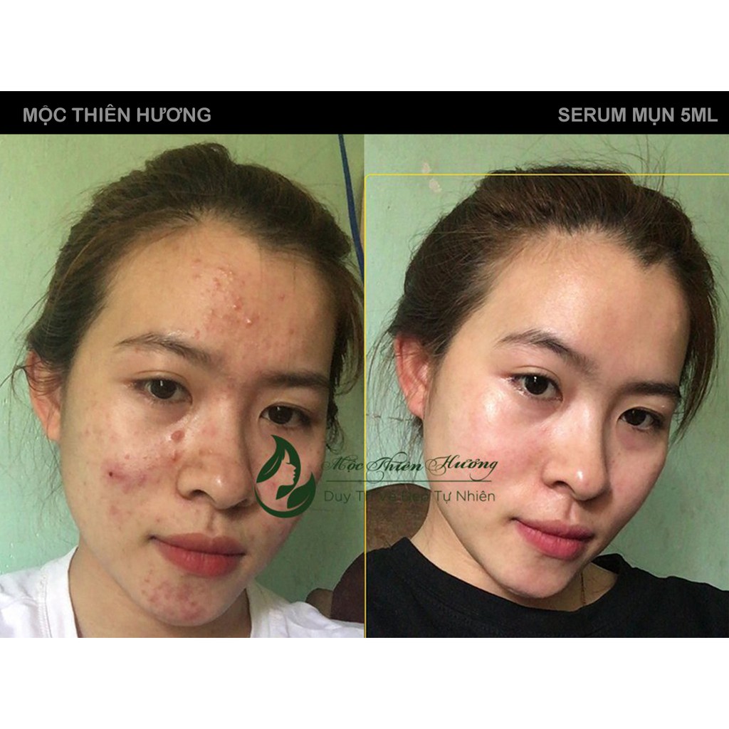 Serum Hết Mụn, Sạch Thâm, Tái Tạo Da | Herbal Anti Acne Serum 100ml Mộc Thiên Hương