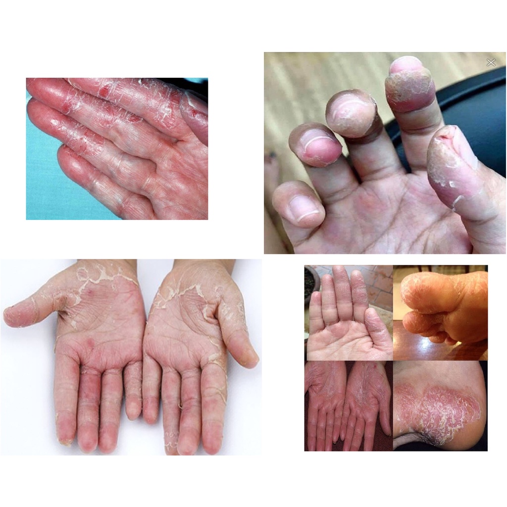 Thảo dược Hết Sạch bong da đầu ngón tay ngón chân, lòng bàn tay, bàn chân