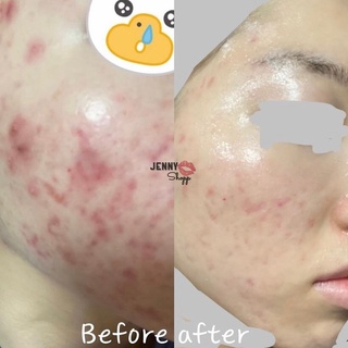 Tinh Chất Giảm Mụn Lumos Acne 5ml