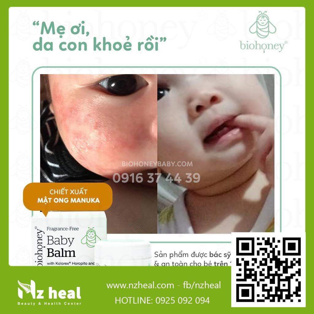 Kem Biohoney Baby Balm - Hết chàm sữa, viêm da, hăm tã, mẩn ngứa cho trẻ