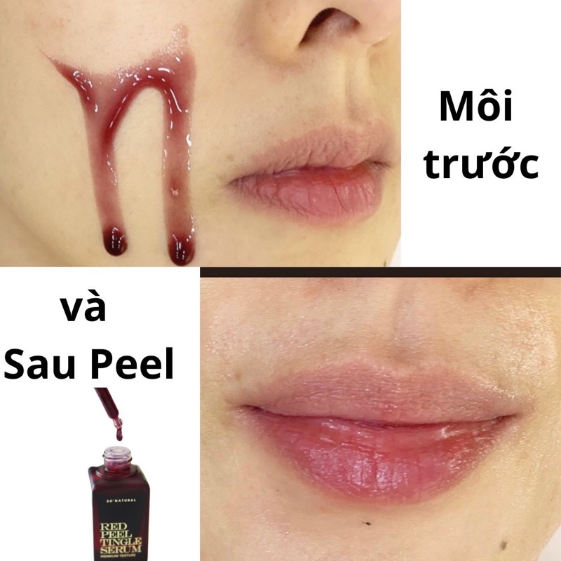 Red Peel Tingle Serum Premium 20ml tinh chất tái tạo peel da sinh học, trắng da, giảm mụn So Natural chính hãng Hàn Quốc