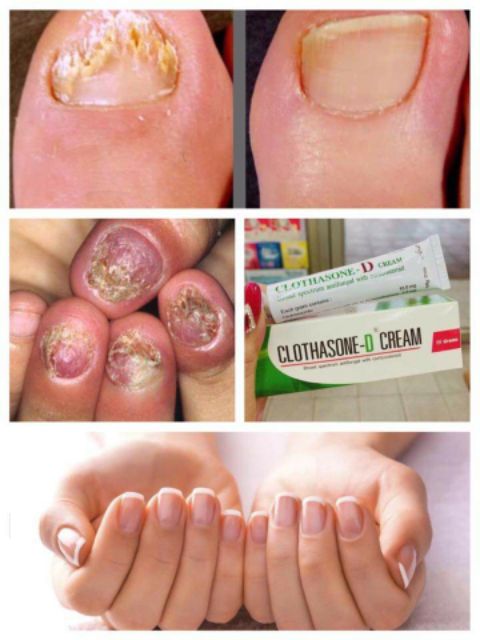 Kem bôi nấm móng tay chân CLOTHASONE-D CREAM 15g Thái Lan