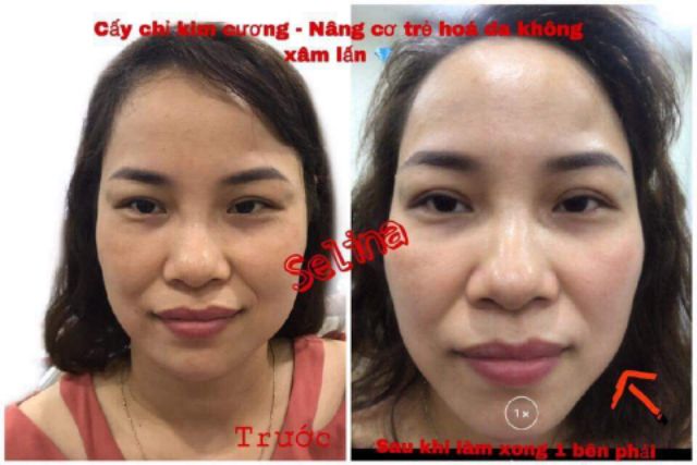 Cấy chỉ kim cương nâng cơ trẻ hóa da