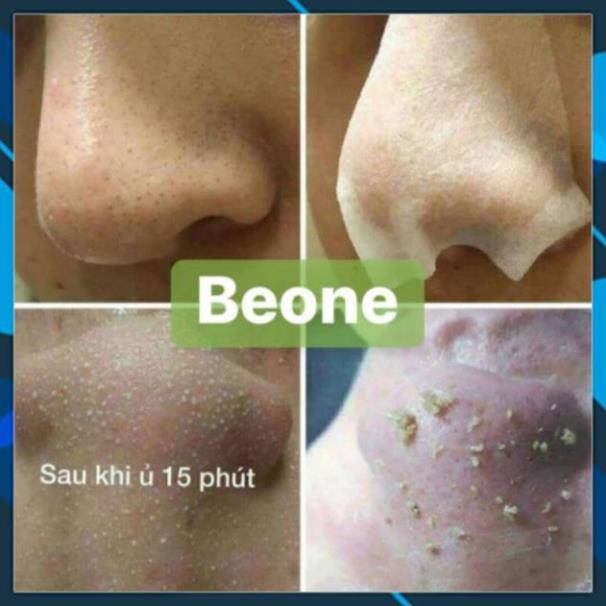 Ủ mụn đầu đen, mụn cám YOUNGER