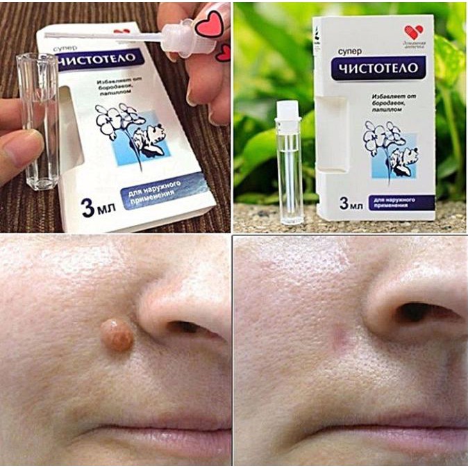 GEL Dvelinil TẨY NỐT RUỒI MỤN CƠM MỤN CÓC SẸO LỒI THỊT THỪA | BigBuy360 - bigbuy360.vn