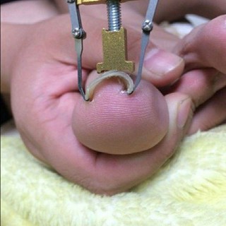 Dụng cụ chữa móng quặp