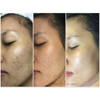 [tách lẻ 1 cặp] Vi kim tảo Ronas