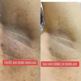 [CHÍNH HÃNG ] SIÊU DƯỠNG THÂM 5S BIHOLADI