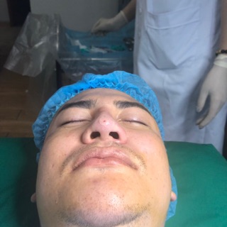 nâng cao đầu mũi- dựng trụ mũi