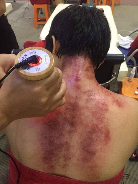 Máy giác hơi thông kinh lạc