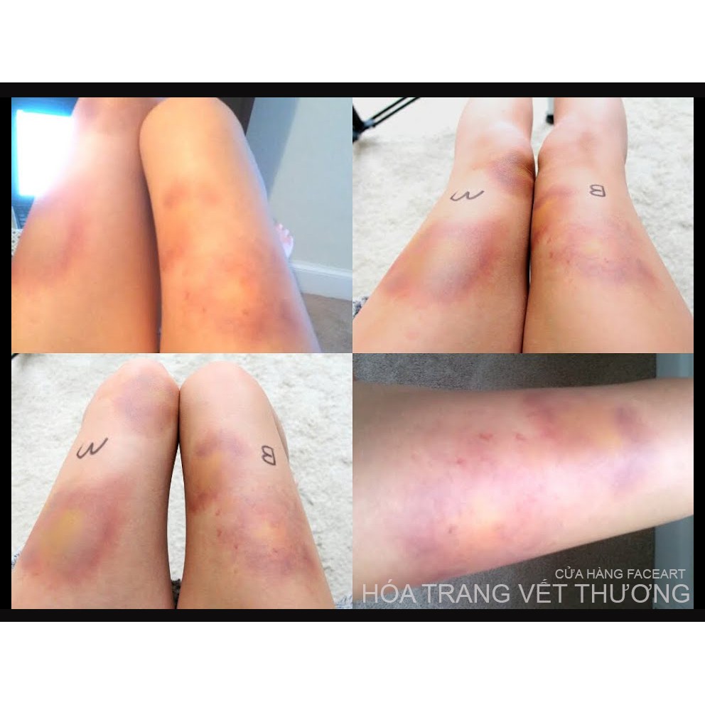 HÓA TRANG VẾT THÂM TÍM, THÂM ĐEN, VẾT NÁM, VẾT BỚT - MÀU HÓA TRANG VẾT THƯƠNG