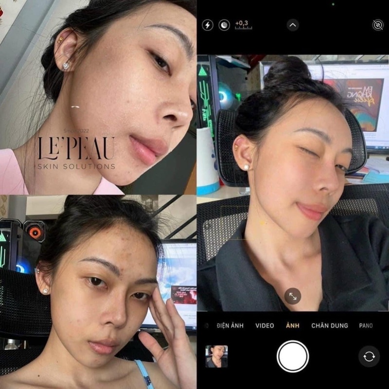 Peel mờ Thâm Mụn, Nám, Tàn Nhang, Sáng da - Tặng Serum B5 phục hồi da -  Peel da Vi Tảo Retinol - LE’PEAU