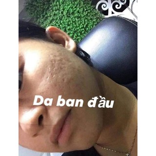 PEEL TCA USA CHẤM SEO THAM NAM DOI MOI