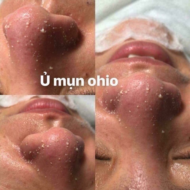 Ủ mụn Ohio