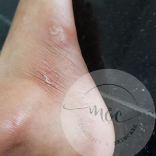 Mặt nạ tẩy tế bào chết chân