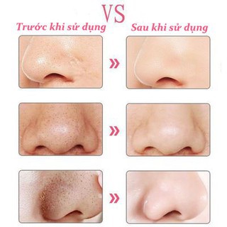 Máy Hút Mụn Đầu Đen Mini Cầm Tay Blackhead Cao CấpTặng 3 Đầu Hút Đa Năng