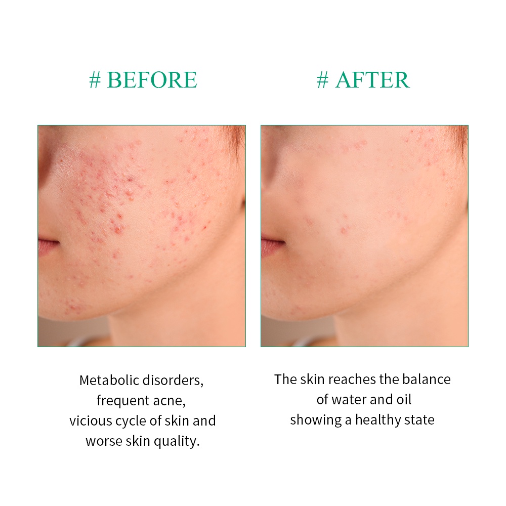 Breylee Tinh Chất Tràm Trà Hỗ Trợ Giảm Mụn Dưỡng Ẩm Sâu Chăm Sóc Da 100ml