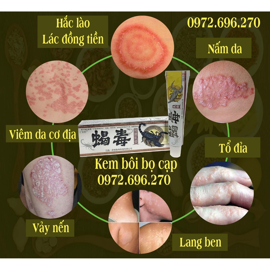 Kem bôi da liễu bọ cạp - Chuyên nấm ngứa á sừng, vảy nến, mề đay, tổ đỉa lâu năm | BigBuy360 - bigbuy360.vn