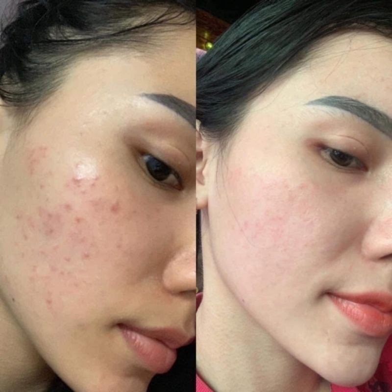 Thảo mộc ngăn ngừa mụn | BigBuy360 - bigbuy360.vn