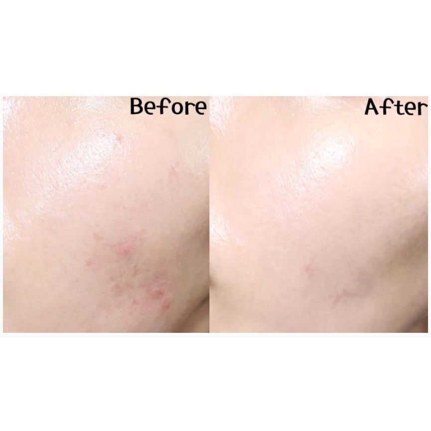 Kem Dưỡng Hỗ Trợ Giảm Mụn, Phục Hồi Da Mụn Chiết Xuất Rau Má Skin1004 Madagascar Centella 75ml