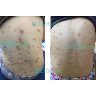 Xịt Dizigone làm sạch da