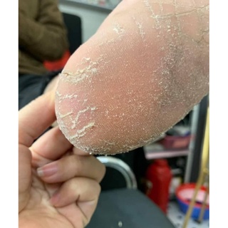 Ủ chà gót chân
