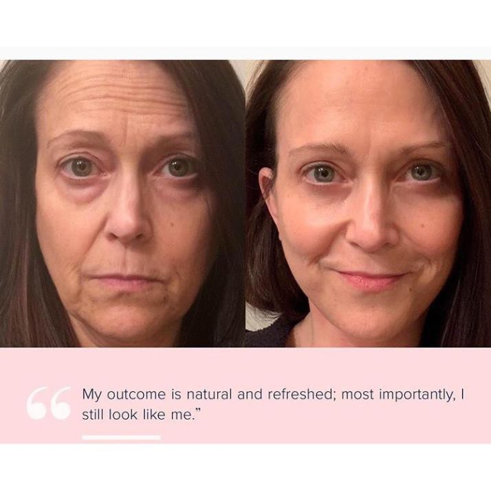 Big Gel 60 Cặp Facial Galvanic Nuskin