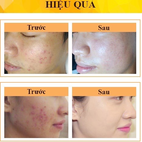 Demar Forte Gel  Advance  - Loại Bỏ Mụn Thâm -- Bản Mới | BigBuy360 - bigbuy360.vn