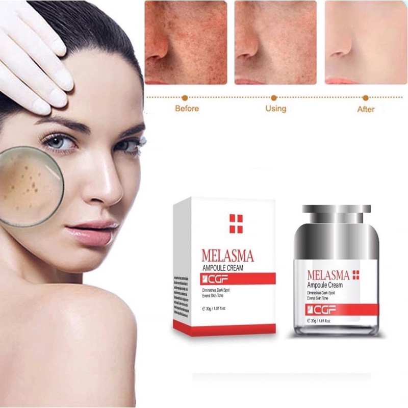 CGF - Kem nám Melasma