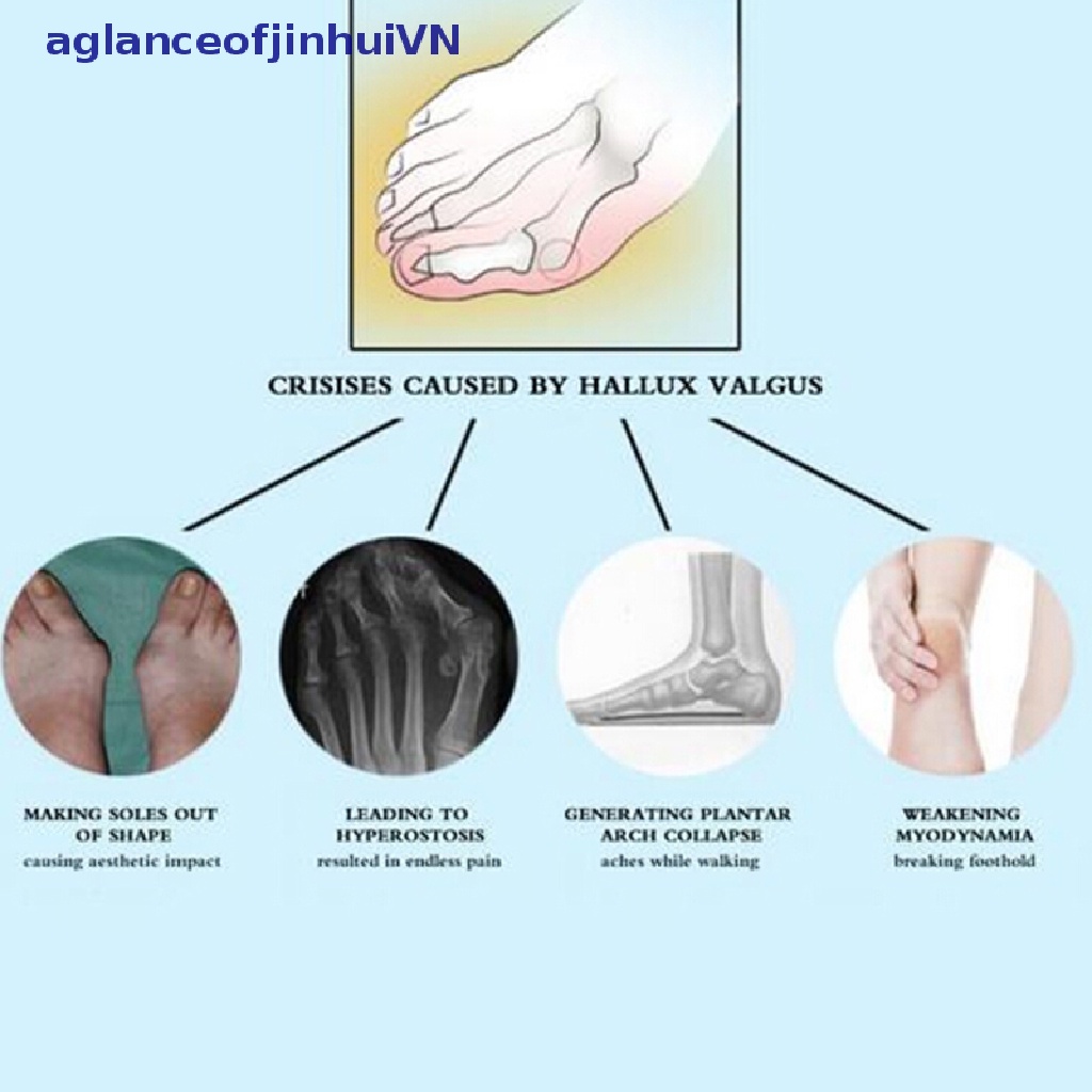 1 Nẹp Chỉnh Hình Ngón Chân Cái Giảm Đau Chỉnh Được