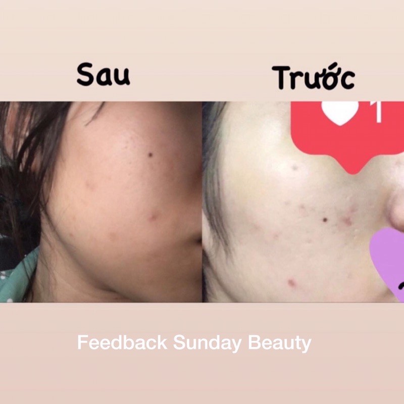 Combo kem thâm & mụn handmade Sunday Beauty