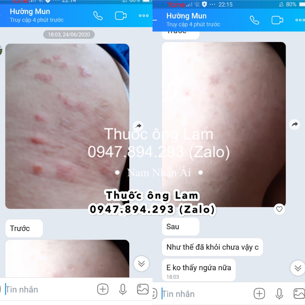 Hắc lào, nấm bẹn dứt điểm Đông Y gia truyền Ông Lam | BigBuy360 - bigbuy360.vn