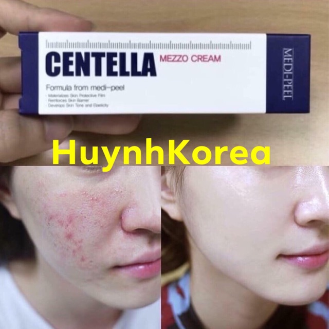 Kem đặc trị MỤN Centella Hàn Quốc 30ml