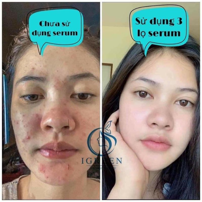 Serum SẠCH MỤN DIẾP CÁ IRGEEN_ GIẢM MỤN, GIẢM THÂM , SE KHÍT LỖ CHÂN LÔNG, SÁNG DA | BigBuy360 - bigbuy360.vn