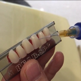 Răng giả tập gắn đá đắp khểnh