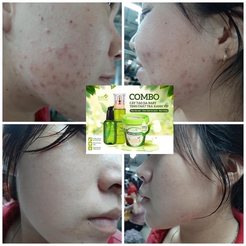 TINH CHẤT TRÀ XANH VIP KIMNATURAL