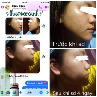 [Sỉ] Thảo Mộc Xanh Mụn 5 lọ 5ml