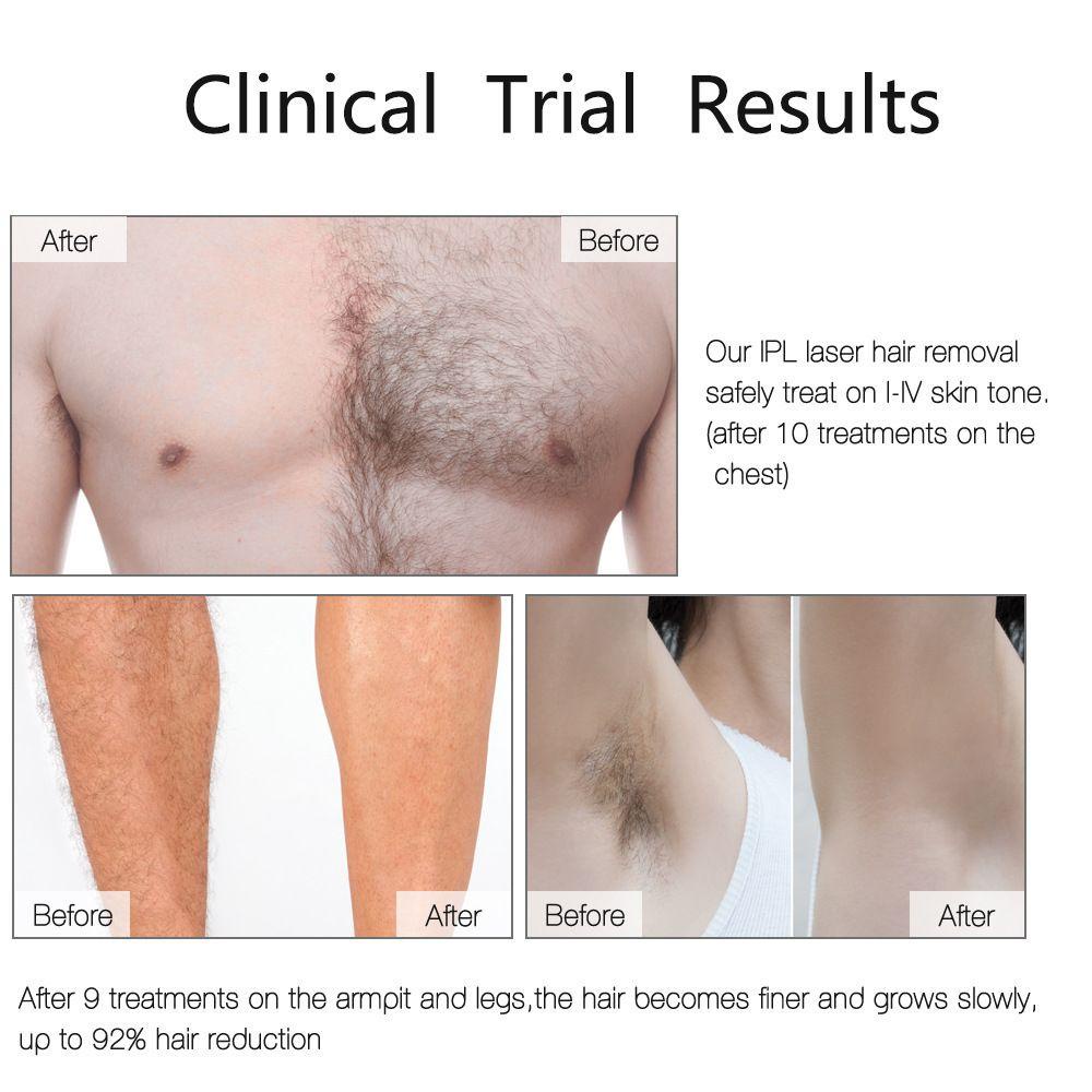 ME Máy Triệt Lông Bằng Tia Laser IPL Dành Cho Nam Và Nữ