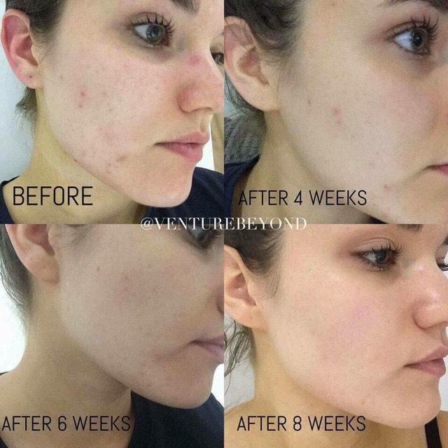 Kem giúp giảm mụn Epoch Blemish Treatment 15ml